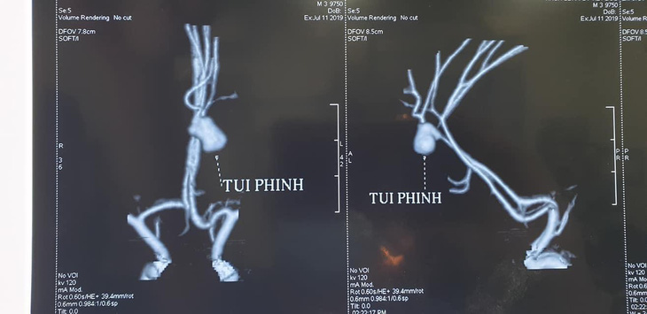 Bác sĩ kinh ngạc khi gặp ca phình mạch não vỡ ở trẻ 3 tuổi - Ảnh 1.