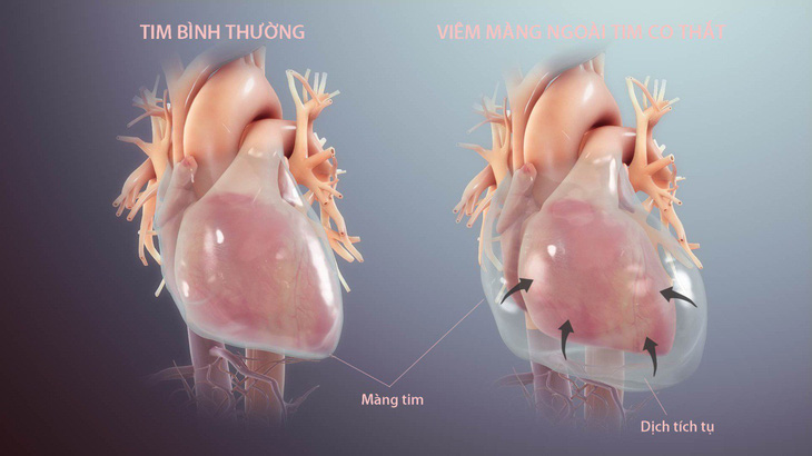 Bệnh viêm màng ngoài tim co thắt có thể dẫn tới suy tim - Ảnh 1.