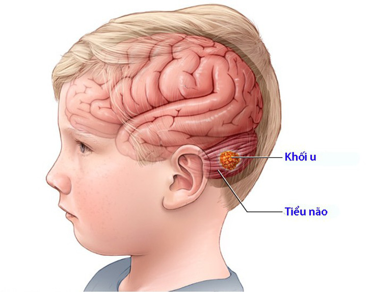 U tiểu não ở trẻ em - Ảnh 1.