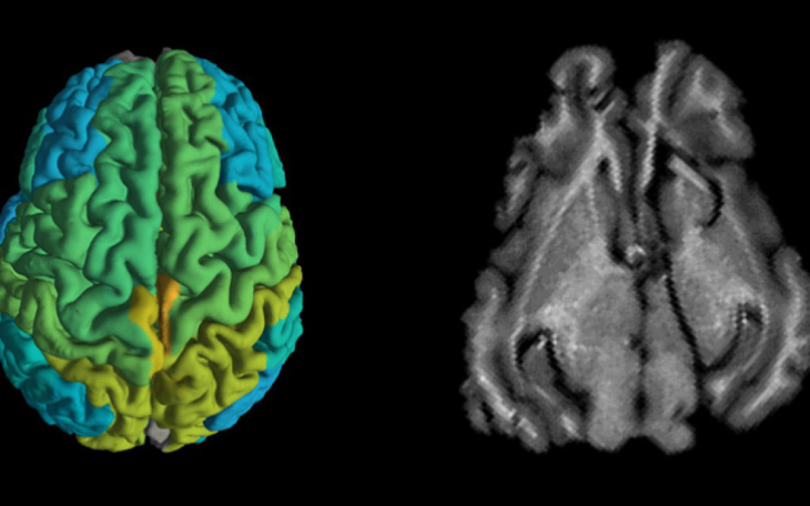 Kỹ thuật MRI mới giúp sớm phát hiện các căn bệnh thoái hóa thần kinh - Ảnh 1.