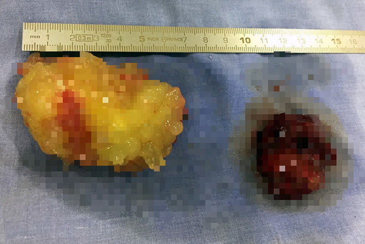 Mổ lấy 2 khối u nhầy di động trong buồng tim bệnh nhân - Ảnh 1.