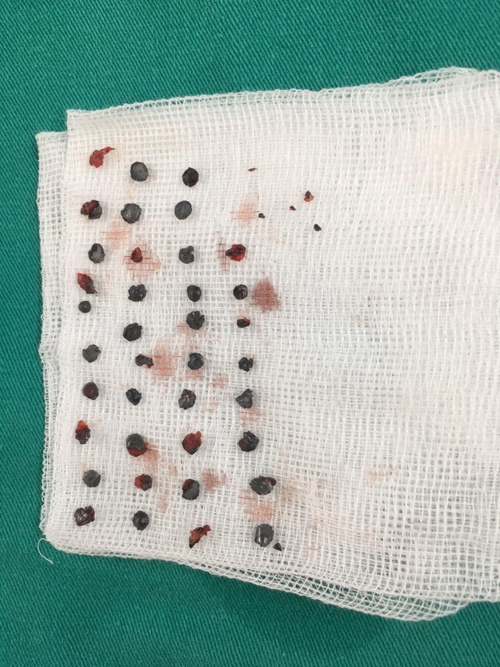 Lấy 39 viên đạn hoa cải nằm 7 tháng trên vùng mặt bệnh nhân - Ảnh 2.