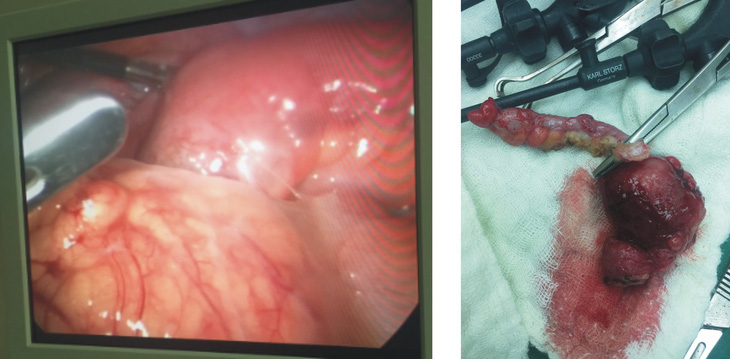 BV Tâm Trí Đồng Tháp: Phẫu thuật nội soi cắt ruột thừa do viêm túi thừa Meckel - Ảnh 1.