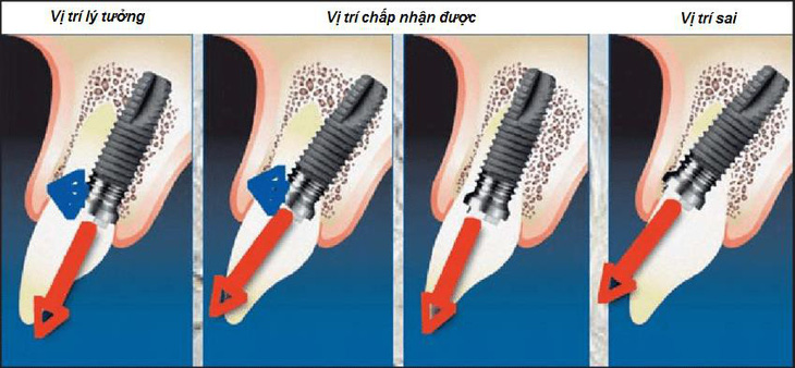 Những biến chứng nguy hiểm khi trồng răng thất bại - Ảnh 2.