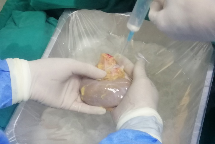 Bệnh viện Đa khoa Thanh Hóa ghép thận thành công từ người chết não - Ảnh 3.
