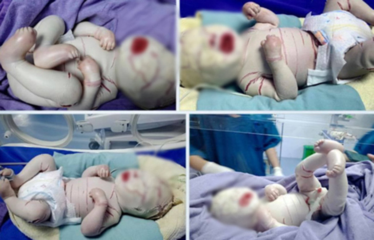 Thêm 1 bé sơ sinh mắc bệnh hiếm, toàn thân bọc vảy trắng nhiều vết nứt - Ảnh 1.