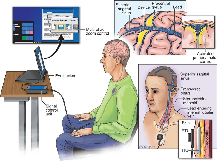 Kết nối não người với máy tính qua… mạch máu - Ảnh 1.