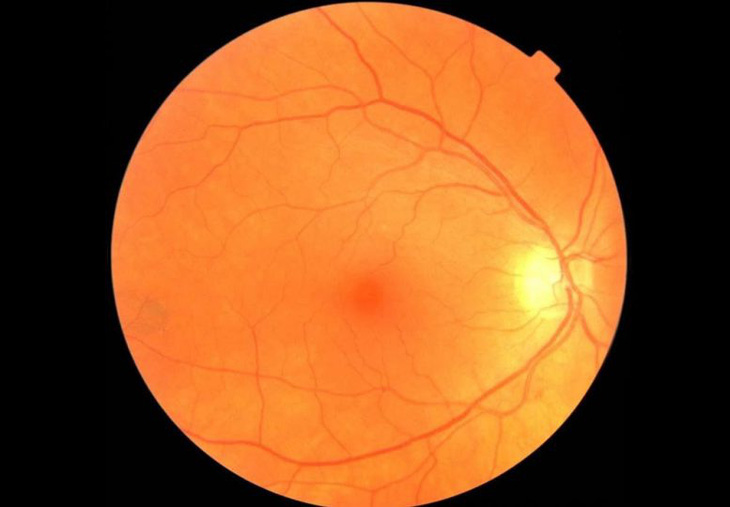 Khám mắt bằng AI giúp phát hiện sớm bệnh Parkinson - Ảnh 2.