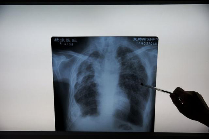 AI phát hiện COVID-19 từ ảnh X-quang phổi nhanh gấp 10 lần chuyên gia - Ảnh 1.