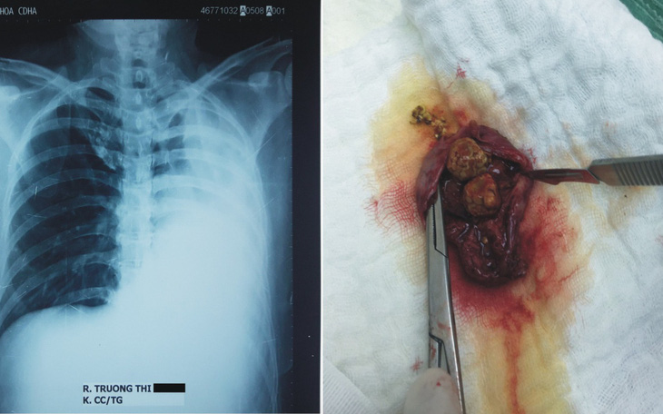 Phẫu thuật cắt túi mật nội soi do sỏi trên bệnh nhân chỉ có 1 lá phổi