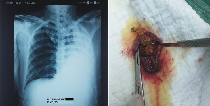Phẫu thuật cắt túi mật nội soi do sỏi trên bệnh nhân chỉ có 1 lá phổi - Ảnh 1.