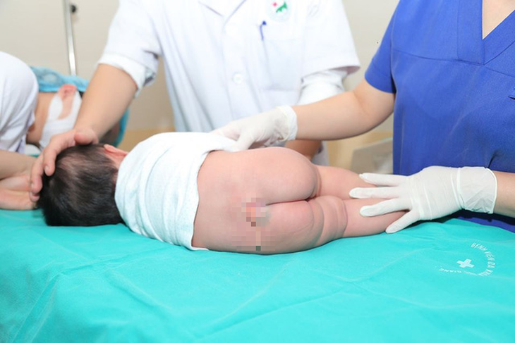 Phẫu thuật cho bé gái 5 tháng có đuôi bẩm sinh dài 9,5cm - Ảnh 1.
