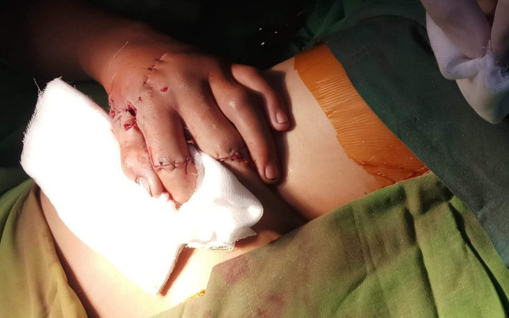 Bé trai 15 tuổi giập nát bàn tay trái do pháo tự chế
