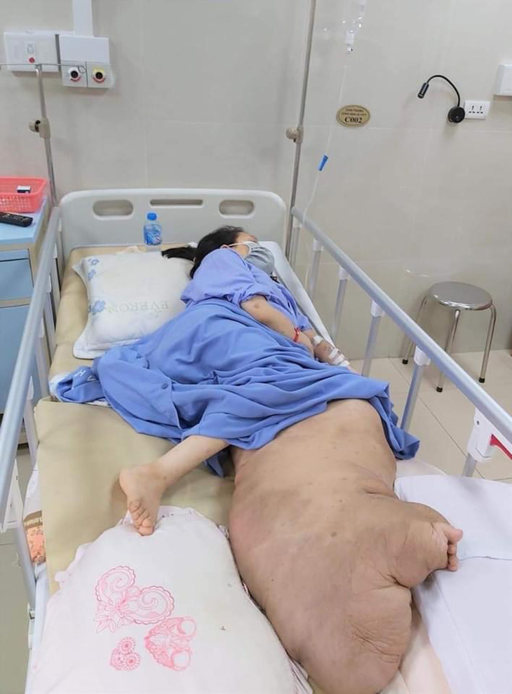 Phẫu thuật giải cứu chân trái khổng lồ, nặng 42kg cho cô gái 25 tuổi - Ảnh 1.
