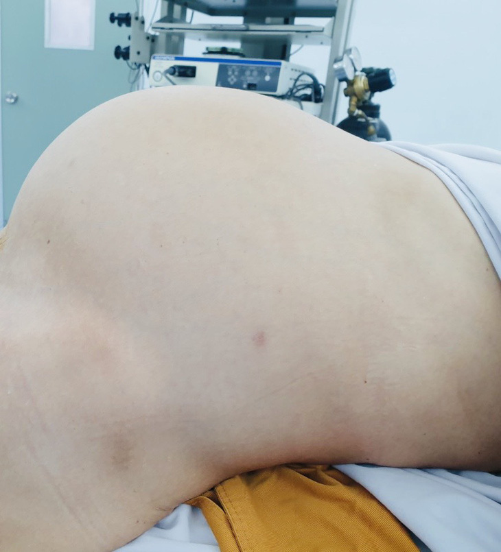 Cắt khối u buồng trứng lớn như có bầu 9 tháng cho nữ bệnh nhân - Ảnh 1.