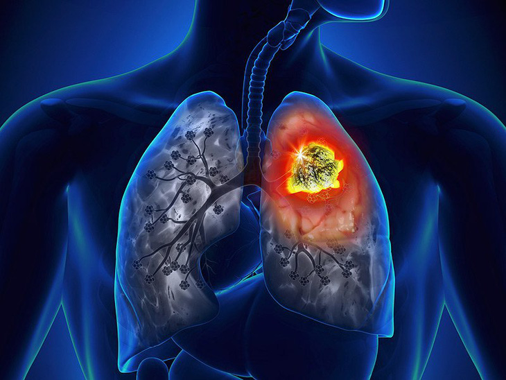 Phát triển phương pháp điều trị ung thư phổi mới đầy hứa hẹn - Ảnh 1.