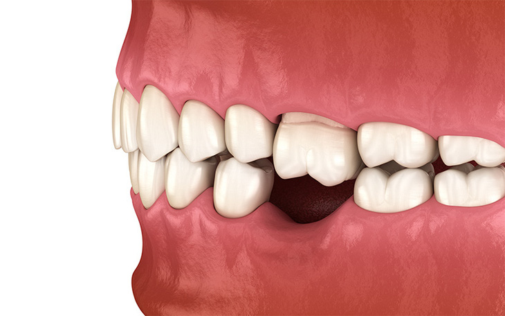 Trồng Implant khôi phục răng vĩnh viễn, tự tin tận hưởng cuộc sống - Ảnh 1.