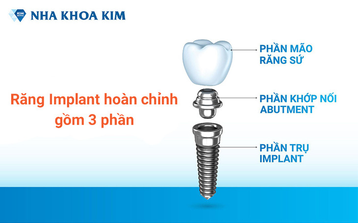 Trồng Implant khôi phục răng vĩnh viễn, tự tin tận hưởng cuộc sống - Ảnh 2.