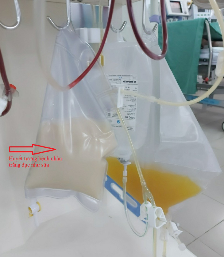 Bệnh nhân bị viêm tụy cấp có huyết tương trắng đục như sữa - Ảnh 1.