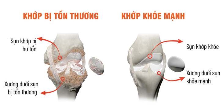 Sống tự chủ hơn nhờ chăm sóc xương khớp đúng cách - Ảnh 2.