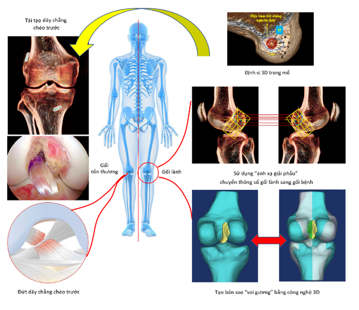 Vinmec tái tạo chính xác dây chằng chéo trước khớp gối với phương pháp “ánh xạ giải phẫu” - Ảnh 3.