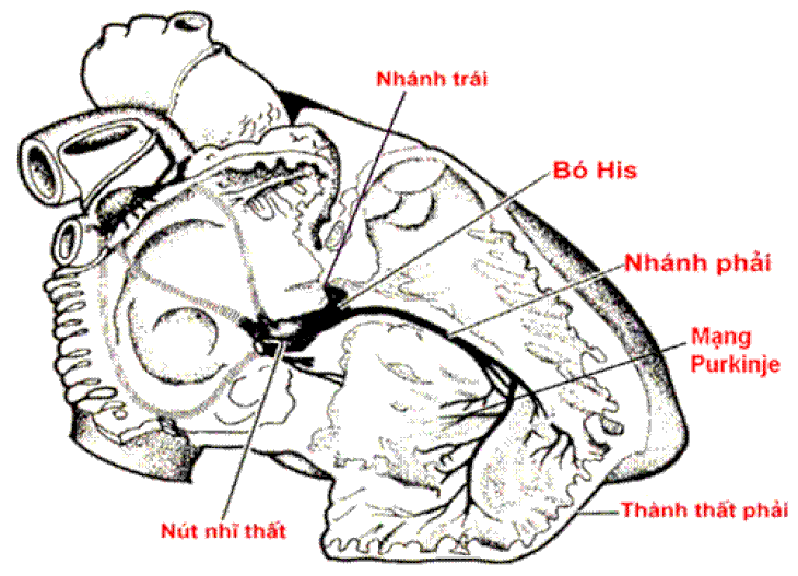 Tin vui cho người suy tim: Ca đầu tiên thực hiện thành công kỹ thuật tạo nhịp tim từ bó his trái - Ảnh 2.