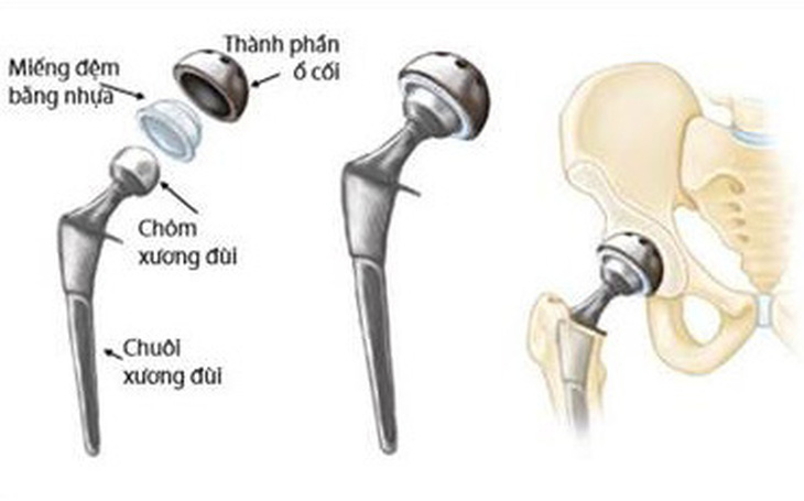 Khớp háng nhân tạo - cứu cánh giúp bệnh nhân gãy cổ xương đùi tránh tàn phế