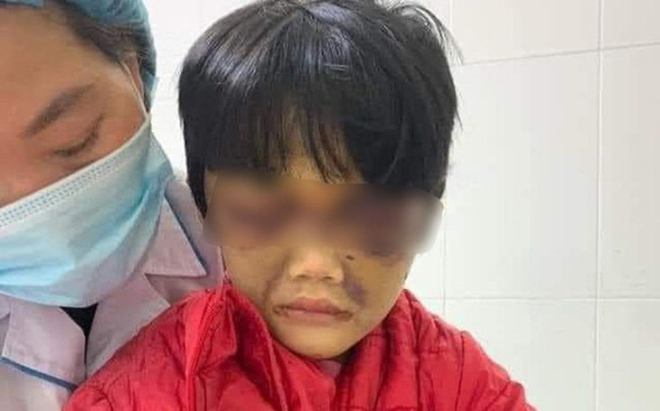 Bé gái 6 tuổi bị mẹ ruột đánh thâm tím mặt, tinh thần hoảng loạn