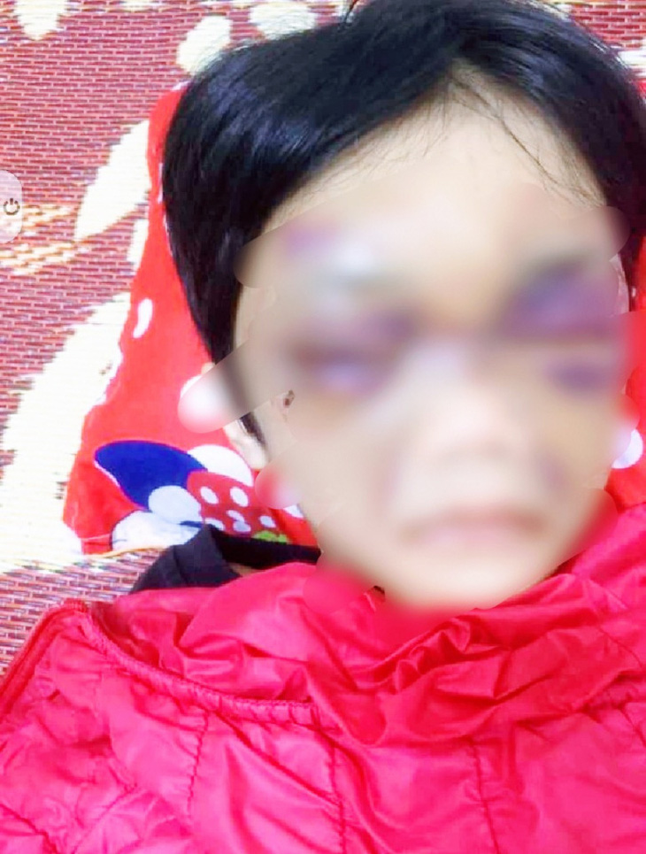 Bé gái 6 tuổi bị mẹ ruột đánh thâm tím mặt, tinh thần hoảng loạn - Ảnh 1.