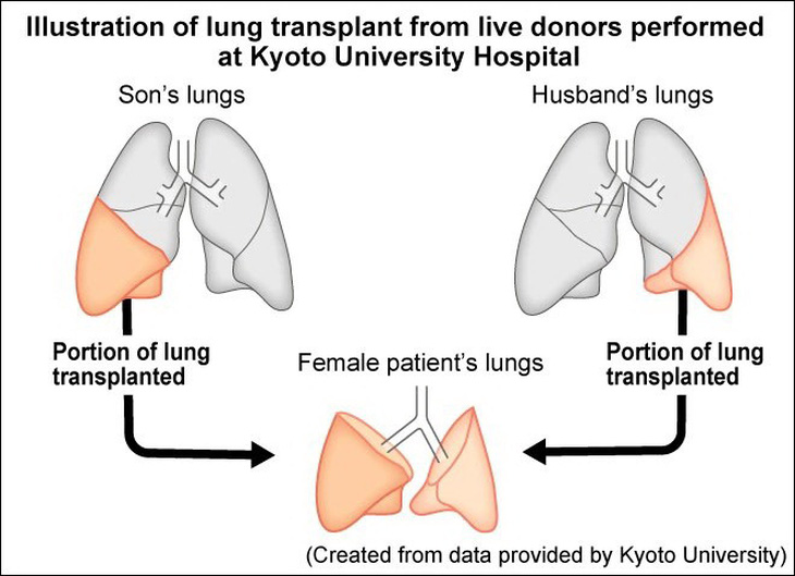 Lần đầu tiên trên thế giới: Ghép phổi từ 2 người sống cho bệnh nhân COVID-19 - Ảnh 2.