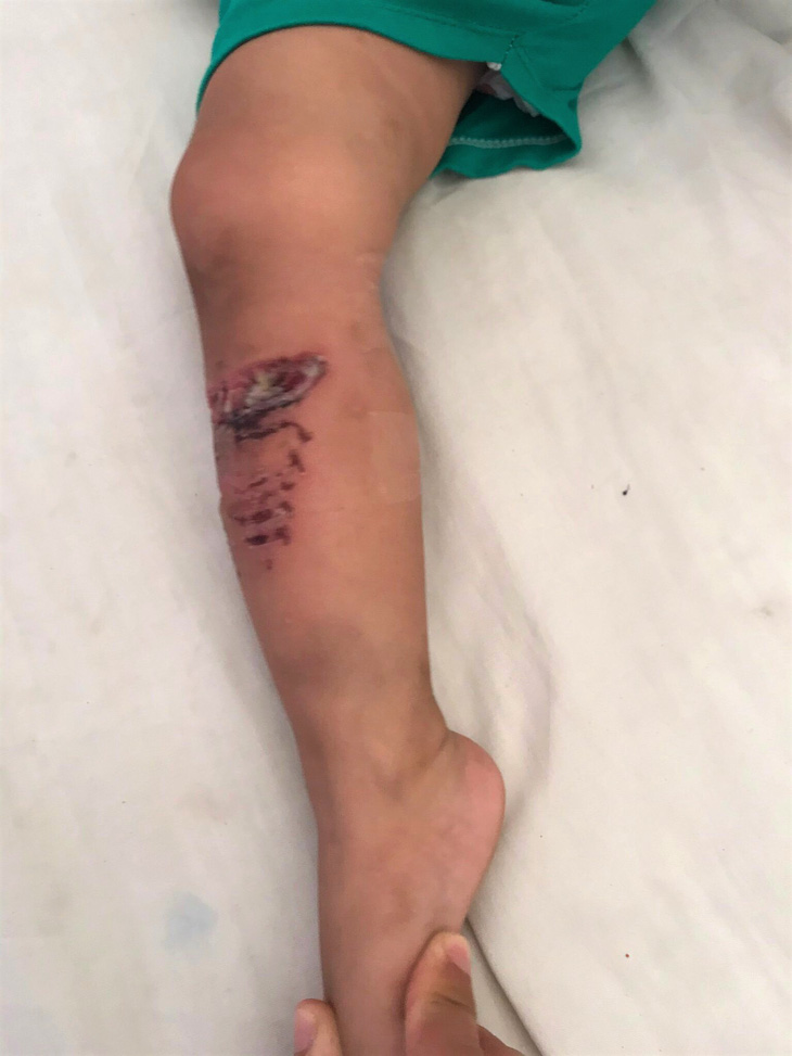 Một cháu bé tại Khánh Hòa bị chó Pitbull cắn nhập viện - Ảnh 1.