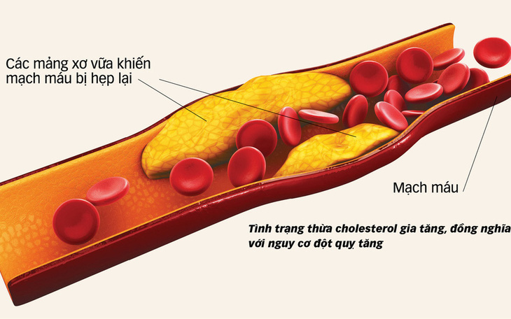 Kiểm soát thừa cholesterol: giảm 27% nguy cơ đột quỵ