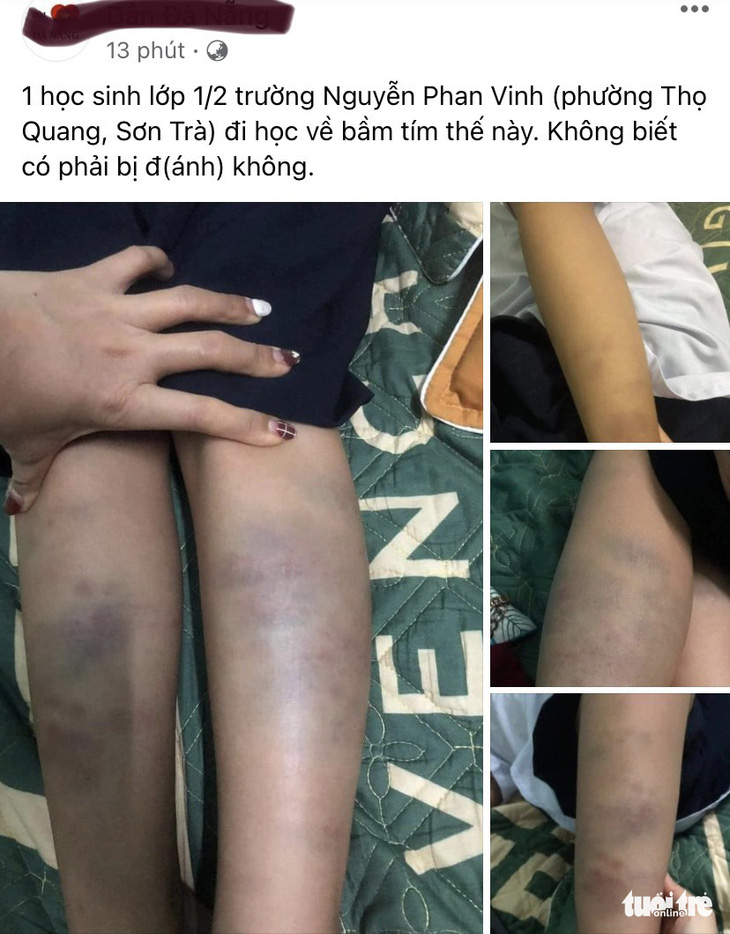 Xác minh vụ học sinh lớp 1 ở Đà Nẵng bị bầm tím chân tay khi đi học về - Ảnh 1.