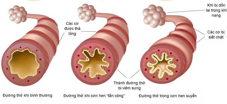 Giải pháp hỗ trợ cải thiện ho, khò khè, khó thở - Ảnh 1.