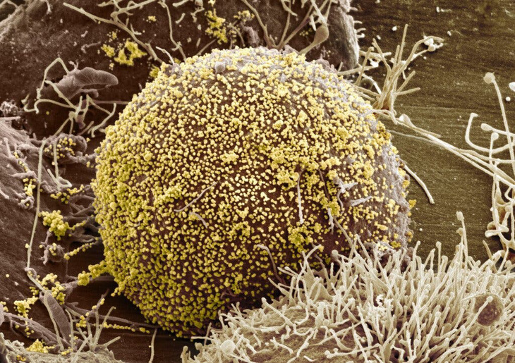 Người phụ nữ hết sạch virus HIV sau khi cấy ghép tế bào gốc - Ảnh 1.