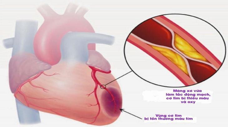 Thông tin cần biết về nhồi máu cơ tim cấp - Ảnh 1.