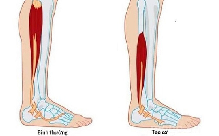 Bị teo chân có thi bằng lái xe tự động được không?