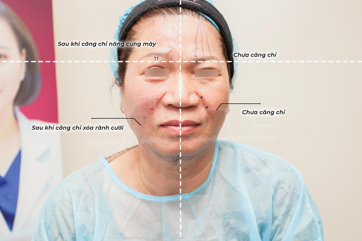 Bác sĩ Nguyễn Phương Thảo giải đáp những điều cần biết về căng da bằng chỉ - Ảnh 2.