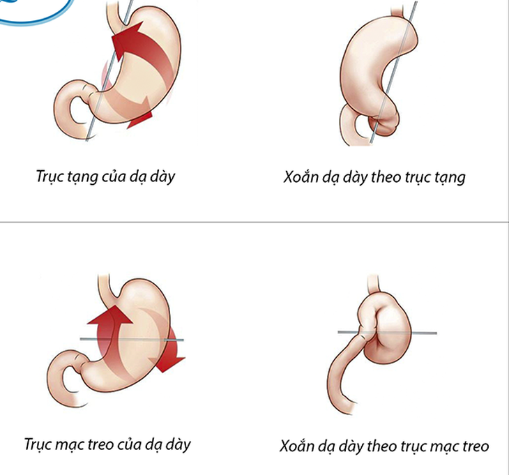 Bé gái 3 tuổi xoắn dạ dày 180 độ hiếm gặp - Ảnh 1.