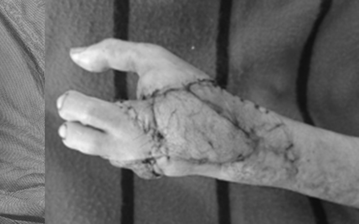 Phẫu thuật chuyển ngón chân thành ngón tay cho bệnh nhân bị máy xay thịt cuốn nát