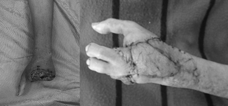 Phẫu thuật chuyển ngón chân thành ngón tay cho bệnh nhân bị máy xay thịt cuốn nát - Ảnh 1.