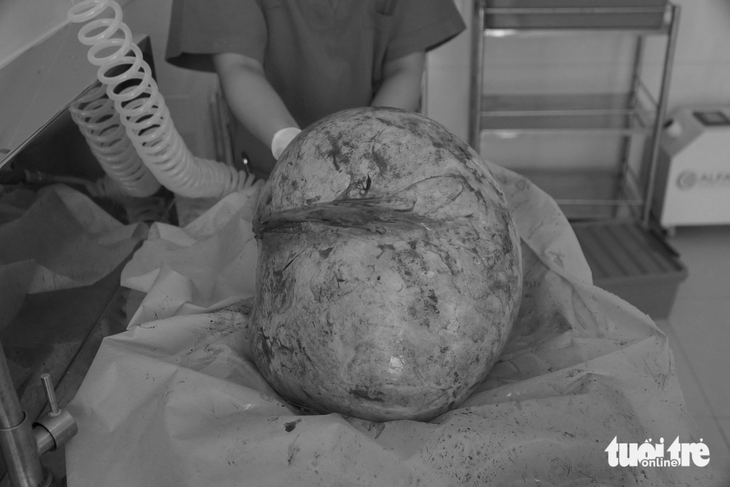 Khối u nang buồng trứng nặng hơn 16kg được các bác sĩ lấy ra từ bụng nạn nhân - Ảnh: Bệnh viện cung cấp