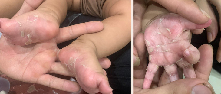 Lòng bàn tay, bàn chân trẻ bong tróc vảy do mắc bệnh giang mai bẩm sinh - Ảnh: BVCC