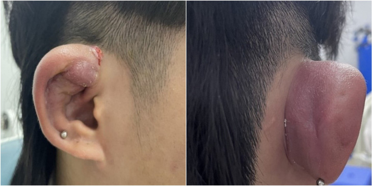 Hình ảnh vành tai bị sưng vù, biến dạng sau khi xỏ khuyên - Ảnh: BVCC