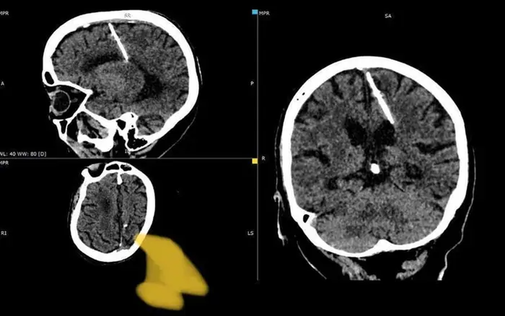 Bà cụ sống khỏe với cây kim trong não suốt 80 năm