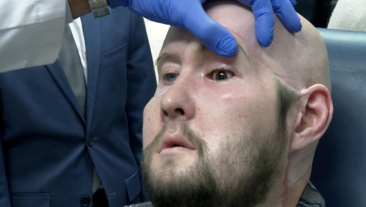 Các bác sĩ kiểm tra mắt trái của ông James vào tháng 10-2023 - Ảnh: CTV News