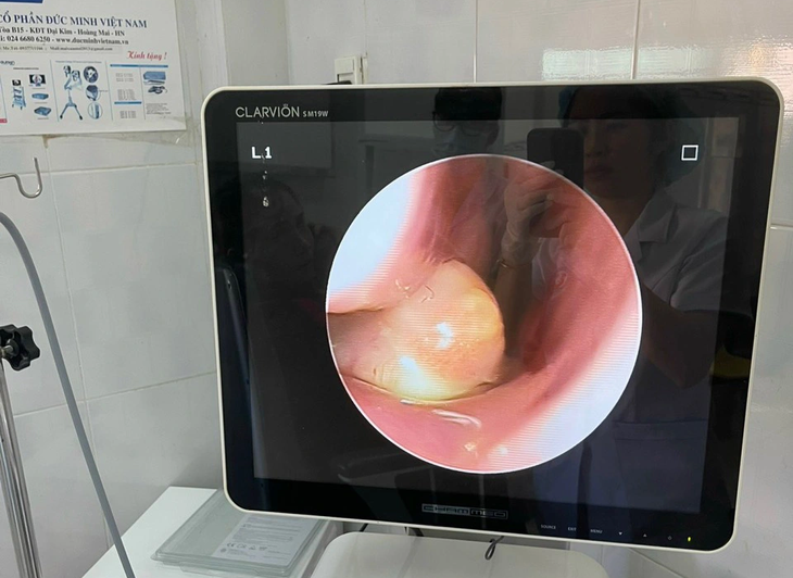 Hình ảnh chiếc răng mọc trong khoang mũi bệnh nhân 4 tuổi - Ảnh: Bệnh viện Nhi Gia Lai