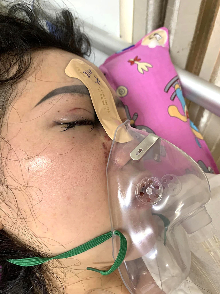 Năm 2022, chị T.T.V. (27 tuổi, trú huyện Hòa Vang, Đà Nẵng) bị mù mắt phải do bị biến chứng sau khi tiêm filler nâng mũi - Ảnh: Người nhà nạn nhân cung cấp