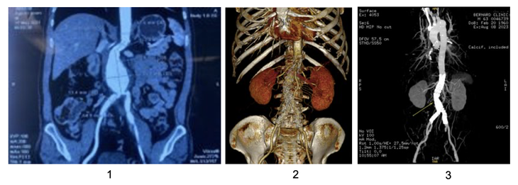 Từ trái qua phải: Hình 1 – Túi phình động mạch chủ bụng được phát hiện qua chụp CT; Hình 2 - Dựng hình mạch máu tái tạo 3D trên CT scan sau đặt stent graft; Hình 3: Hình chụp CT động mạch chủ sau điều trị đặt stent graft (Nguồn: Bernard Healthcare)