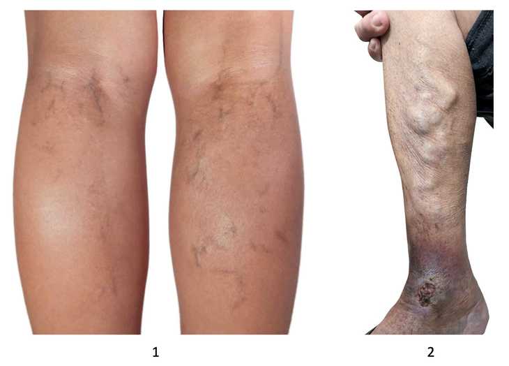 Hình từ trái qua phải: Hình 1 - Cấp độ nhẹ chân nổi gân xanh tím; Hình 2: Cấp độ nặng, chân nổi búi to (phía trên) và biến chứng loét tĩnh mạch (phía dưới) – Nguồn: Bernard Healthcare